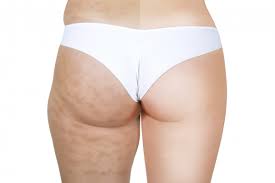 Cellulite verwijderen met Pascaud Wave